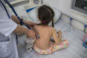 Aumentan los casos de sarampión en el mundo: 10,3 millones de personas se infectaron en 2023