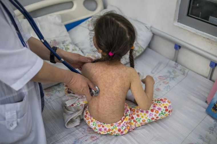 Aumentan los casos de sarampión en el mundo: 10,3 millones de personas se infectaron en 2023
