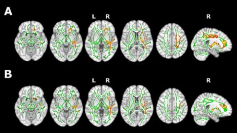 El insomnio provoca cambios cerebrales relacionados con etapas tempranas del alzhéimer